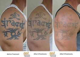 Complete guide results subscribe for more videos! Tattoo Removal Before And After Reddit Tattoo Design