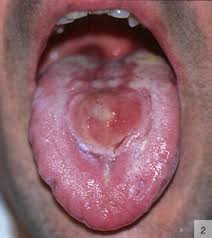 Image result for syphilis ulcer