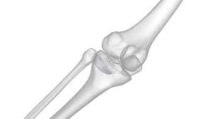 Yanlis Kemik Kaynamasi Nasil Duzeltilir Kapsulbilgi