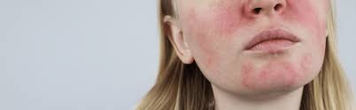 Image result for red rash face