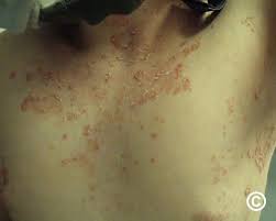 Image result for Pemphigus