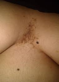 Seudoacantosis Nigricans Dermatologo Net