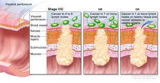 With the other subsidiary problems, a constant. Colon Cancer Treatment Pdq Patient Version National Cancer Institute