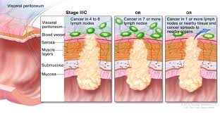 Of course, i had read the statistics on stage four colon cancer. Colon Cancer Treatment Pdq Patient Version National Cancer Institute