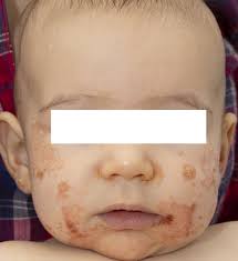 Clinical and Experimental Dermatology: Vol 47, No 8