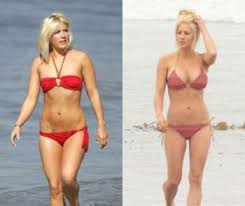 Pin On Breast Augmentation In Dallas Texas