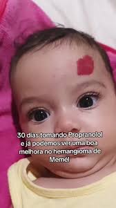 Melhora no Hemangioma: Propranolol em 30 Dias