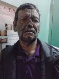 Programa Nacional de Control de Lepra