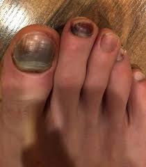 Black Toenail Treatment Causes Prevention Blister Prevention