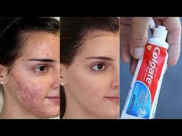 I Applied Colgate Toothpaste An Vaseline On My Face In One Night The Next Day This What Happen Youtub Colgate Toothpaste Vaseline For Face Lighten Dark Spots