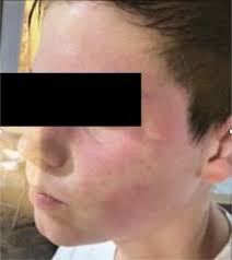 Image result for Exercise-Induced Anaphylaxis