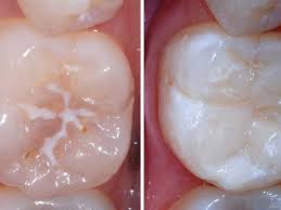 Ought to you not have sealants and not get decay? Dental Sealants