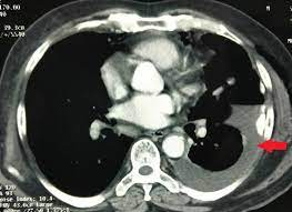 Your guide to what a ct scan is and how it is used to stage testicular cancer the stage of the cancer means how big it is and whether it has spread. Cureus Prostate Carcinoma And Pleural Mesothelioma An Extremely Rare Co Occurrence