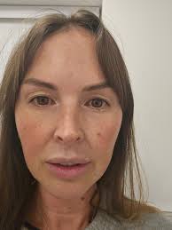 I am getting my upper bleph (& a rhinoplasty) done in Turkey in a month.  What do you recommend I take with me for after care & comfort. Note: I have  been