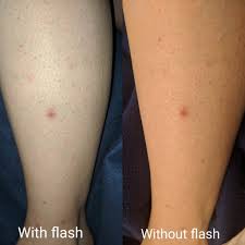 Leg Bio Oil Before And After Scars Skin Concerns Had An Ingrown Hair On My Leg I Pulled It Out And Several Days Later This Spot Is Still There Ingrown Hair Ingrown Leg Hair Treat Ingrown Hair