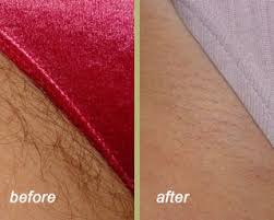 The exposure to sunlight on treated skin can change skin color permanently. Laser Hair Removal Chevy Chase Md Skin Lrg