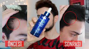 1700 sac teli cikaran tonik denser hair aras barlas youtube