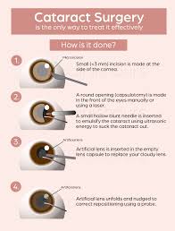 Jul 16, 2021 · a cataract is a clouding of the lens in your eye. Early Signs Symptoms Of Cataract Clearvision Singapore