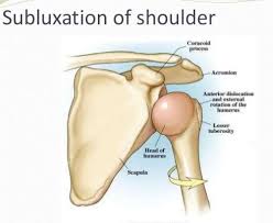 Image result for Shoulder Subluxation