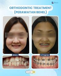 Punya masalah gigi berantakan dan mau dirapikan? Dan masih bingung mau  pilih clear aligner atau behel? 🤔 Postingan ini pas banget buat kamu  sebagai bahan pertimbangan. Namun, kamu tetap perlu konsultasi ke