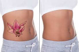We either need to make sure that we make a wise choice about our tattoo or to not get one at all. How Laser Tattoo Removal Works Calista Skin And Laser Center Calista Skin Laser Dfw