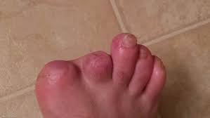Image result for toe amputation