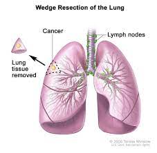 The malignant disease which affects a lung is known as lung cancer. Department Of Surgery Non Small Cell Lung Cancer