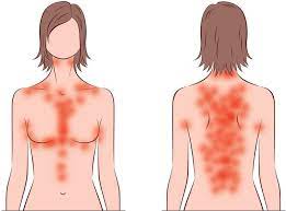 Keto Rash Why You May Itch On Low Carb And What To Do About It Keto Rash Kidney Disease Symptoms Gluten Rash