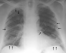 Pleural plaques are small areas of thickened tissue in the lung lining, or pleura. Asbestos When The Dust Settles An Imaging Review Of Asbestos Related Disease Radiographics