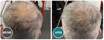 By the end of the study period, 73% of the subjects reported high effectiveness in hair regrowth and reducing balding areas ( 2, 8 ). Follicle Thought Com Hair Growth Research On Twitter New Company Alert On Follicle Thought Triple Hair Of Canada Is Combining Minoxidil Topical Finasteride A Prostaglandin Drug To Regrow Hair And The
