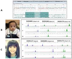 Mosaic conditions like this are observed in only a few cases worldwide, a clear reason for the occurrence is still not clear. Genes Free Full Text Maternal Uniparental Disomy Of Chromosome 20 Upd 20 Mat As Differential Diagnosis Of Silver Russell Syndrome Identification Of Three New Cases Html