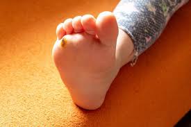 See full list on mayoclinic.org Why Do I Have Warts On My Feet Sean Rosenblum Dpm Podiatry