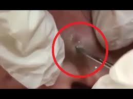 In the video the patient reveals another doctor had biopsied the hard. Blackheads Removal 55 Best Pimple Popping Videos 2019 Youtube Makeup Life Hacks Honey Face Cleanser Pimple Popping