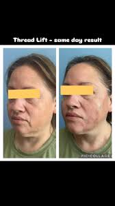 Mini face lift with threads near me in Chicago