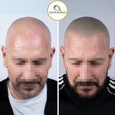 Nuestros resultados de micropigmentación capilar