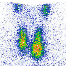 Struma multinodosa mit kalten knoten (mit bildern) kalte knoten sind bereiche in der schilddrüse, die keine hormone mehr produzieren und. Nach Wie Vor Nicht Ohne Das Schilddrusenkarzinom Healthcare In Europe Com