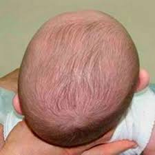 Image result for Positional Head Deformity