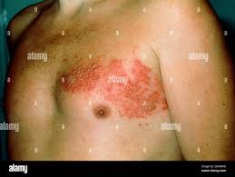 Image result for zoster under breasts