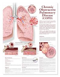 Chronic Obstructive Pulmonary Disease Copd Anatomical Chart 2nd Edition