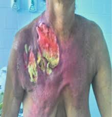 Seriously, one of the worst things you could do to yourself is look up pictures of fournier's gangrene. Fournier S Gangrene Of The Shoulder Girdle Intechopen