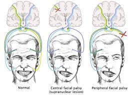 Unlike a stroke, however, bell's palsy usually gets better on its own after a few weeks, according to webmd. Facial Nerve Palsy Knowledge Amboss