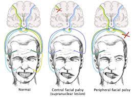 Feb 12, 2020 · a stroke is brain damage caused by interruption of blood supply to an area of the brain, either by a blockage of arteries (ischemic stroke) or by bleeding into brain tissue after a blood vessel ruptures (hemorrhagic stroke). Facial Nerve Palsy Knowledge Amboss