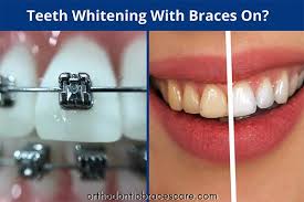 How do you make yourself get braces? Orthodontic Braces Care Invisalign Ceramic Lingual Braces For Adults Tips