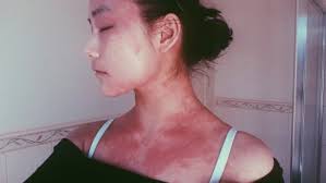 Help ITSAN: raising awareness for Red Skin Syndrome