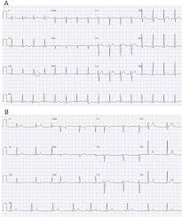 Symptoms can include shortness of breath, chest pain, decreased ability to exercise, and an irregular heartbeat. Covid 19 Associated Suspected Myocarditis As The Etiology For Recurrent And Protracted Fever In An Otherwise Healthy Adult The American Journal Of The Medical Sciences