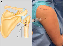 Image result for Axillary Nerve Block