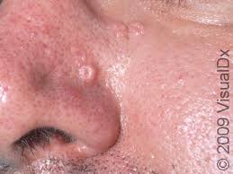 Image result for Sebaceous Hyperplasia