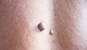The nonstick and smooth formula of that is highly recommended to patients. Anal Warts Skin Tags Orange County Hemorrhoid Clinic