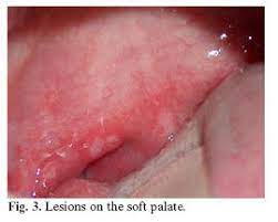 Papular Purpuric Gloves And Socks Syndrome Presentation Of A Clinical Case