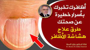 يتراوح سعر جلسة علاج دوالي الساقين بالكويت ما بين 400: ÙÙ„ÙŠÙ†ØªØ¨Ù‡ Ù„Ù‡Ø§ Ø§Ù„Ø¬Ù…ÙŠØ¹ Ø£Ø¸Ø§ÙØ±Ùƒ ØªØ®Ø¨Ø± Ø¨Ø£Ø³Ø±Ø§Ø± Ø®Ø·ÙŠØ±Ø© Ø¹Ù† ØµØ­ØªÙƒ ÙˆØµÙØ© Ø·Ø¨ÙŠØ¹ÙŠØ© Ù„ØªÙ‚ÙˆÙŠØ© Ø§Ù„Ø§Ø¸Ø§ÙØ± ÙˆØ¬Ø¹Ù„Ù‡Ø§ Ù‚ÙˆÙŠØ© ÙˆØ¨ÙŠØ¶Ø§Ø¡ Youtube